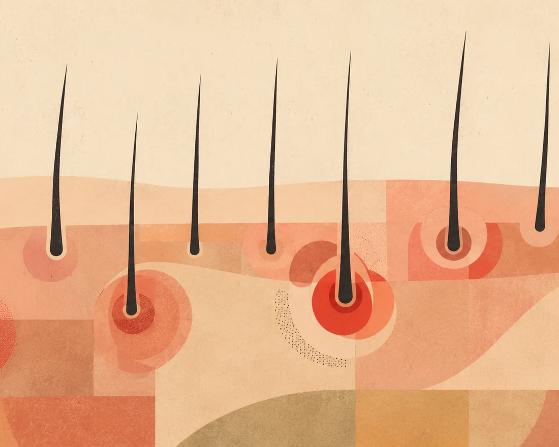 Stylized medical illustration of hair follicles with several areas of surrounding inflammation beneath the skin